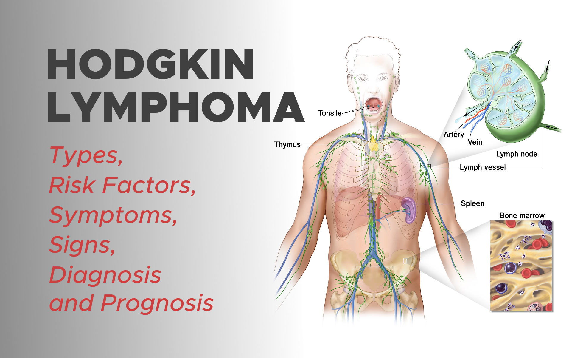 Hodgkin Lymphoma Types, Risk Factors, Symptoms, Signs, Diagnosis and Prognosis EndoGynecology