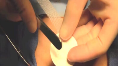 Very Good Technique: Umbilical Hernia Repair