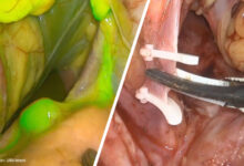 Sentinel Lymph Node Mapping: Indocyanine Green (ICG) Usage in Surgery and Oncology