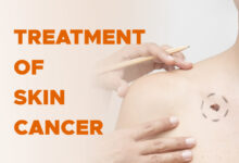 Treatment of Skin Cancer (Non-Melanoma)