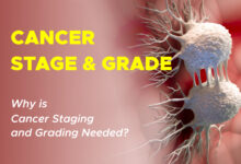 Cancer grade and cancer stafe differences